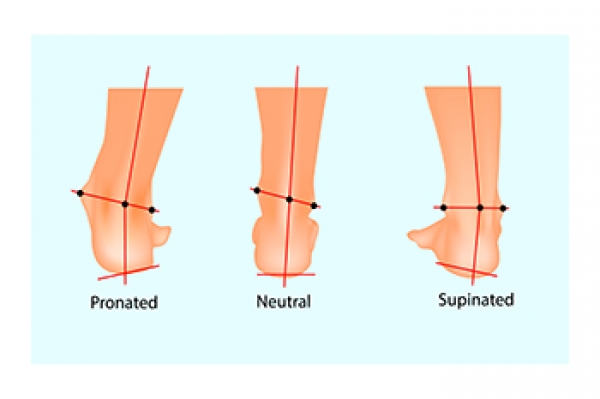 Different types of foot pronation best sale